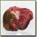 Right Liver Resection Techniques for Advanced Alveolar Echinococcosis with Vascular Invasion
