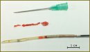 The First Experience of Targeted Catheter Atherectomy in Femoral Arterial Occlusive Disease