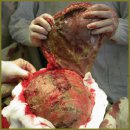 Incarcerated Giant Incisional Ventral Hernia Complicated by Hernial Sac Phlegmon, Unformed Enteric Fistula and Peritonitis