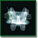 Individual Navigation Templates for Subcortical Screw Placement in Lumbar Spine