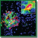 Total Pancreatectomy with Islet Autotransplantation (TPIAT) as a Technique to Treat Chronic Idiopathic Pancreatitis: Early Experience Analysis
