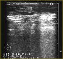 Comparative Analysis of the Use of Non-tension and Traditional Hernioplasty Techniques in Abdominal Hernias of Various Localizations