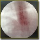 Spinal Cord Epidurial Stimulation for Neuropathic  Pain Syndrome Treatment of Disseminated  Sclerosis Patient	