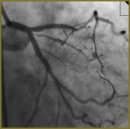 X-ray Endovascular Correction of Bifurcation Involvements of Coronary Arteries. Part I. Classification of Involvements, Their Pathologic Characteristics, Methods of Correction
