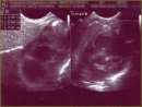 A Case of Right Atrial Thrombosis in a Newborn Infant