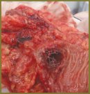 Combined Endoscopic Therapy of Sigmoid Colon Cancer Complicated by Bowel Obstruction in an Extremely Obese Patient