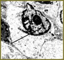 Clinicomorphological Parallels of the Abdominal Cavity and Retroperitoneal Space Organ Neuroendocrine Tumors