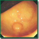 An Ensemble of Convolutional Neural Networks  for the Use in Video Endoscopy