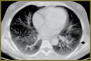 Hepatopulmonary Syndrome: State of a Problem