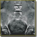 Capabilities of Combined Application of Multislice Linear Digital X-ray Tomography and Ultrasound Examination in Diagnosing Spinal Tuberculous Lesion