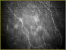 Method of a Confocal Microscopy in Investigation of the Operational Wound Zone (in vivo) After a Cataract Phacoemulsification