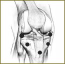 Temperature Response of Knee Joint Tissues in Postoperative Period in Intraarticular Fractures of Condyles of Tibia