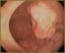 Effective Treatment of Peutz–Jeghers Syndrome Complicated with Enteric Intussusception