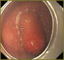 A Case of Intraluminal Endoscopic Suturing of Gastric Perforation
