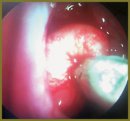 Observation of a Rhinopharynx Tumor (Teratoma) Rare Case