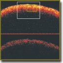 Multiphoton Tomography and Cross-Polarization Optical Coherence Tomography for Diagnosing Brain Gliomas: Pilot Study