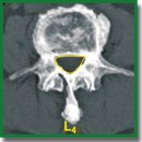 Pedicle-Lengthening Osteotomy for the Treatment of Lumbar Spinal Stenosis: the Surgical Technique (Pilot Clinical Study)