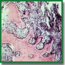 Reconstruction of Fingers Using Skin-Bone Grafts with Microvascular Anastomoses