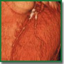 MSCT Coronary Angiography in Diagnosis of Chronic Coronary Occlusions
