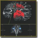 Use of Magnetic Resonance Tractography in Detecting Specific Features of the Impairment of Conduction Pathways and Their Prognostic Value in Parkinson’s Disease Complicated by Freezing of Gait