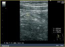 Current State of Acute Appendicitis Diagnosis