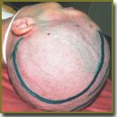 Decompressive Craniotomy in the Treatment of Malignant Ischemic Stroke of Cerebral Hemispheres (Review)