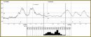 Combined Monitoring (ECG-MT and CGMS) in the Study of Arrhythmogenic Factors in Patients with Diabetes Mellitus Type 2 Suffering from Chronic Cardiac Failure