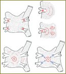 Concomitant Atrial Fibrillation in Patients with Mitral Valve Defects