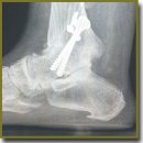 The Concept of Modern Ankle Joint Arthrodesis in Posttraumatic Crusarthrosis, Grade III–IV