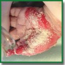 Collost Bioplastic Collagen Material for the Treatment of Burns