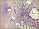Capabilities of Positron Emission Tomography with 18F-fluorodeoxyglucose and 11С-methionine in Determining Pulmonary Tuberculosis Activity: Metabolic and Morphological Parallels