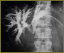 Low-invasive Methods of the Tumoral Genesis Mechanical Jaundice Radial Diagnosis