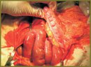 Role of a Morphological Investigation in Diagnosis of a Nonspecific Ulcerous Colitis in Children