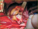 The Diagnostic and Treatment Characteristics of a Rare Morphological Type of Subaortal Stenosis — Dome-Shaped Membrane