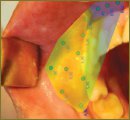Diagnostic Capabilities of Infrared Thermography in the Examination of Patients with Diseases of Maxillofacial Area