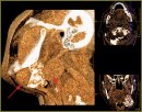 Differential Radiodiagnosis of Salivary Gland Masses