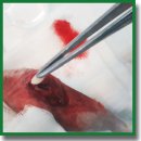 Technology for Repairing Osteomyelitic Bone Defects Using Autologous Mesenchymal Stromal Cells on a Collagen Matrix in Experiment