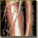 Application of Rotational Computed Tomography Angiography and 3D Modeling in Planning One-Stage Reconstruction of the Pelvic Floor after Evisceration of the Pelvic Organs