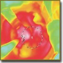 Intraoperational Thermal Control of Perifocal Edema in Photodynamic Therapy of Malignant Brain Tumors