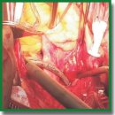 Denervation of Pulmonary Arteries in Patients with Mitral Valve Defects Complicated by Atrial Fibrillation and Pulmonary Hypertension