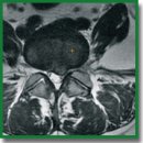 Lumbar Spinal Fusion Using Lateral Oblique (Pre-psoas) Approach (Review)
