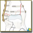 Modern Operative Treatment of Malleolar Fractures  and Associated Consequences (Review)