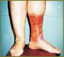 Treatment of a Crus Giant Trophic Ulcer