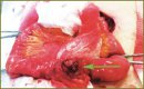 Strangulated Incisional Richter’s Hernia Complicated by Small Bowel Perforation and Phlegmon of Anterior Abdominal Wall
