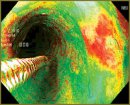 Increasing Information Capacity of Narrow Band Imaging Results in Diagnosis of Premalignant Lesions and Early Cancer of Esophagus