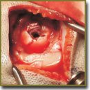 Application of Reperen Miniplate for Minor Calvarium Defect Plasty in Intracerebral Hematoma Removal	
