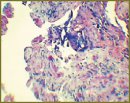 Metastases of Urinary Bladder Cancer into Penile Cavernous Bodies